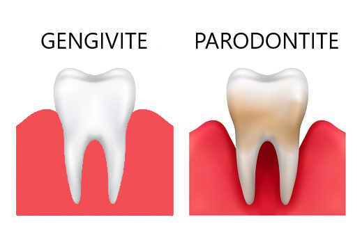 Brillantino dentale - Studio Dentistico Dr. Luca Fedi - Pistoia